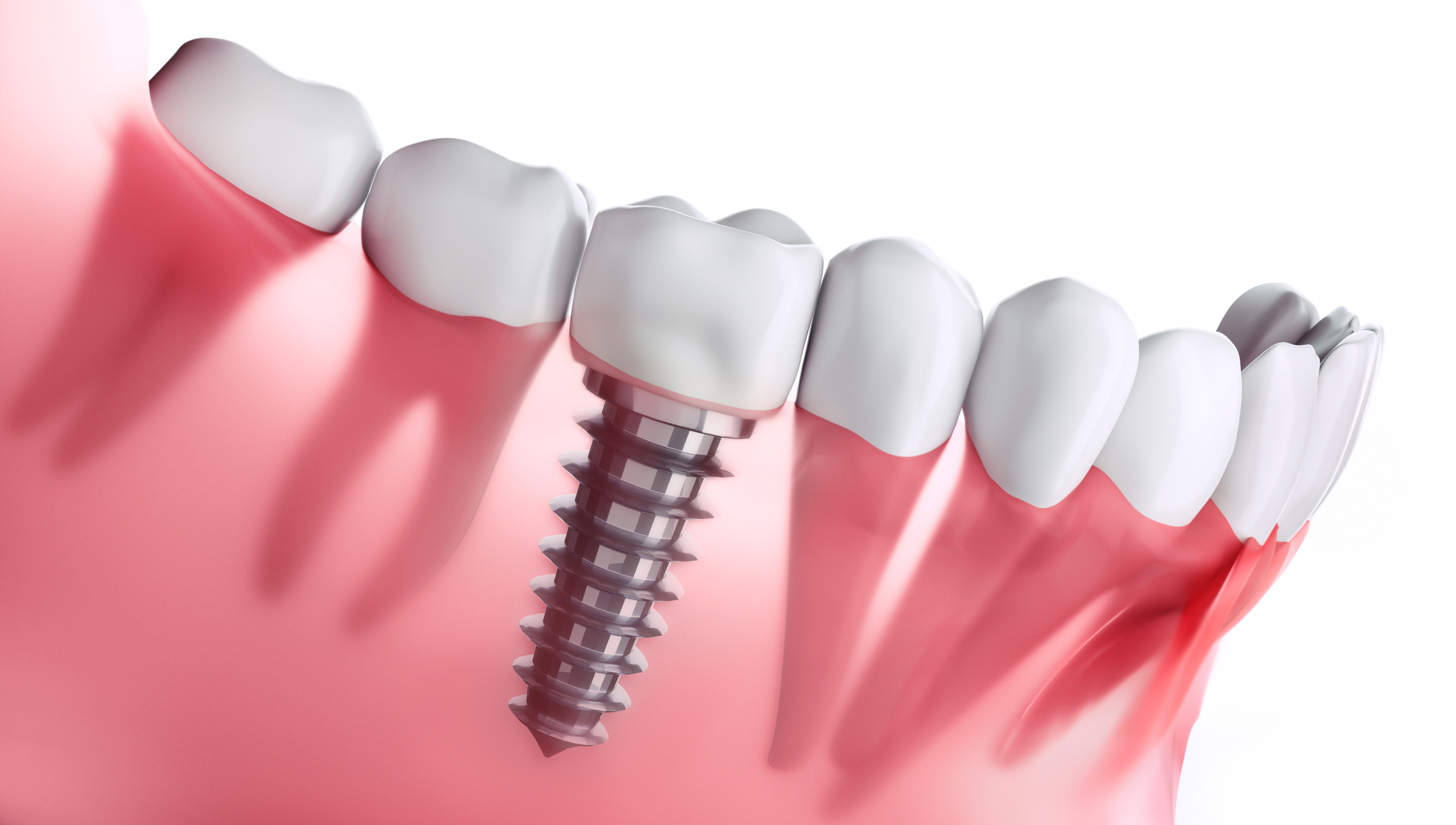 Implanty Zębowe
